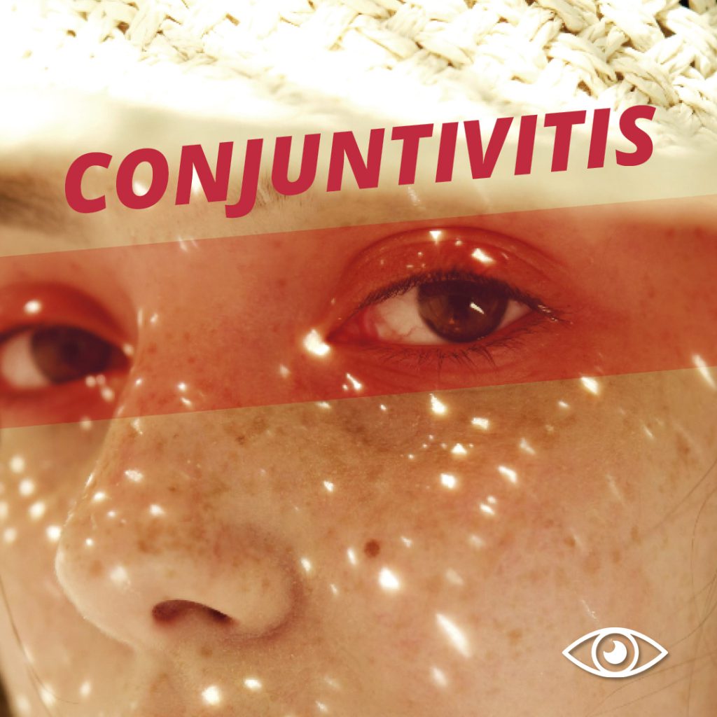 Imagen de la cabecera del post de conjuntivitis